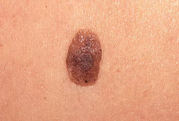 Queratosis Seborreica