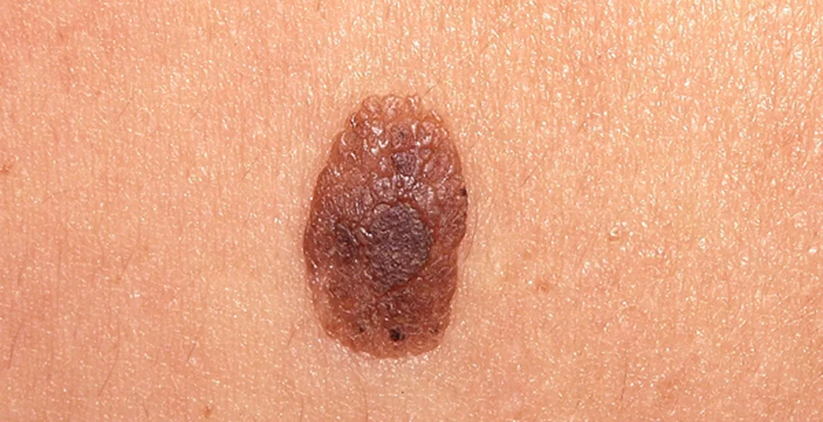 Queratose Seborreica