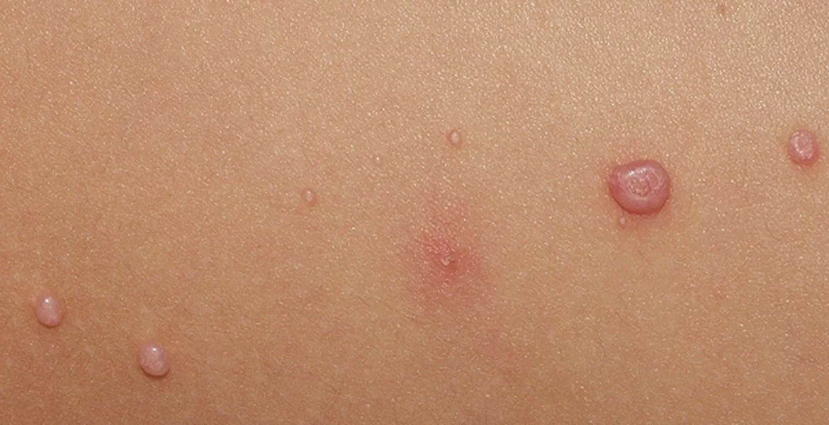Tudo Sobre Molusco Contagioso: Sintomas, Transmissão e Tratamento