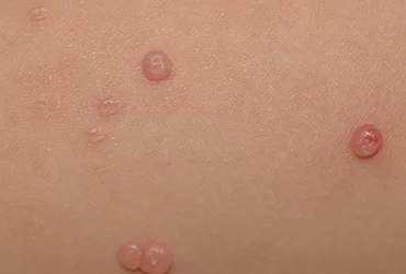 Todo Sobre el Molusco Contagioso: Síntomas, Transmisión y Opciones de Tratamiento