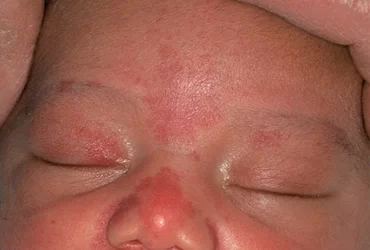 Mancha Salmón o Nevus simplex, que es?