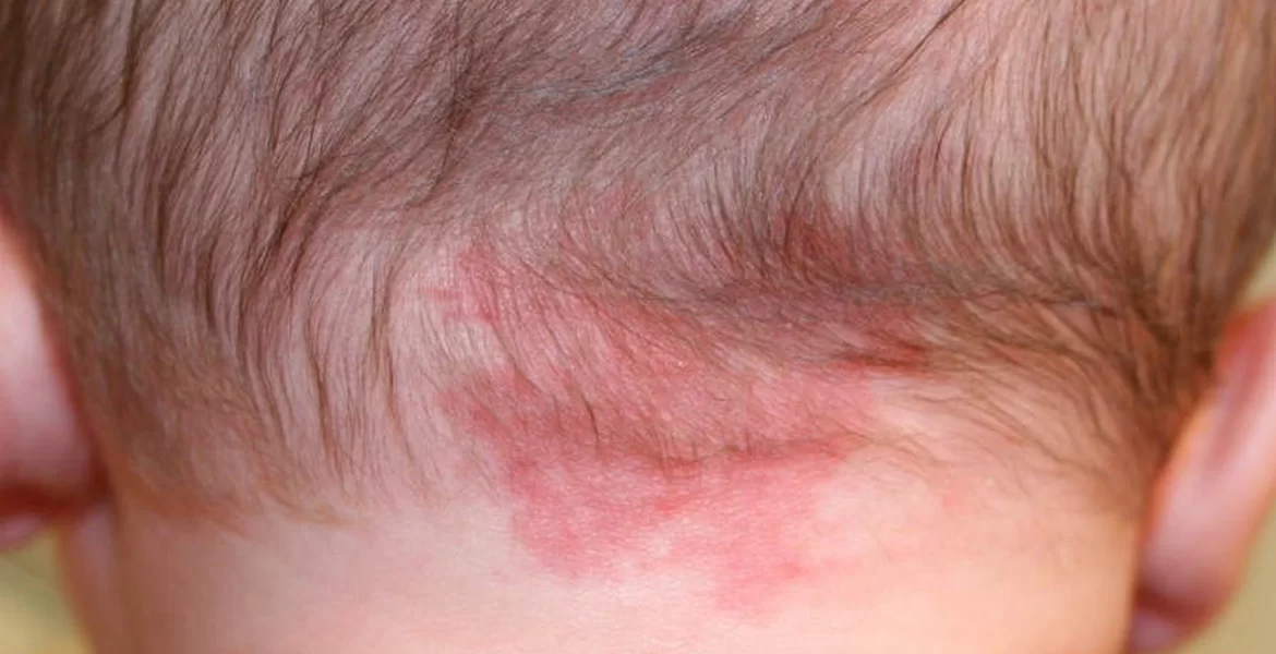 Mancha Salmão ou nevo simplex. uma mancha de nascimento, o que é?