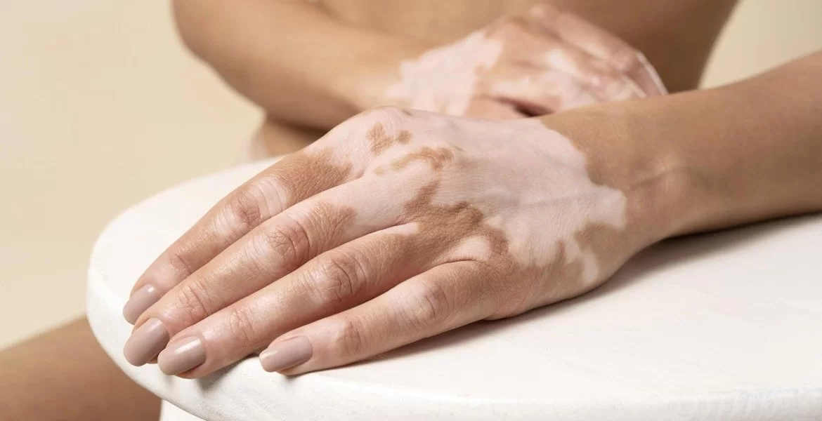 Tudo o que Precisas Saber sobre o Vitiligo: Causas, Sintomas e Tratamentos