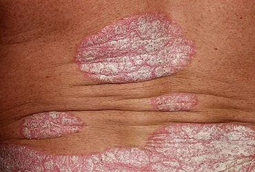 DERMATOSES DESCAMATIVAS