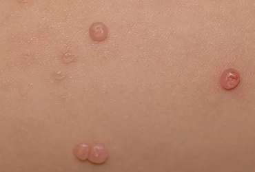 DERMATOSES E DST’s